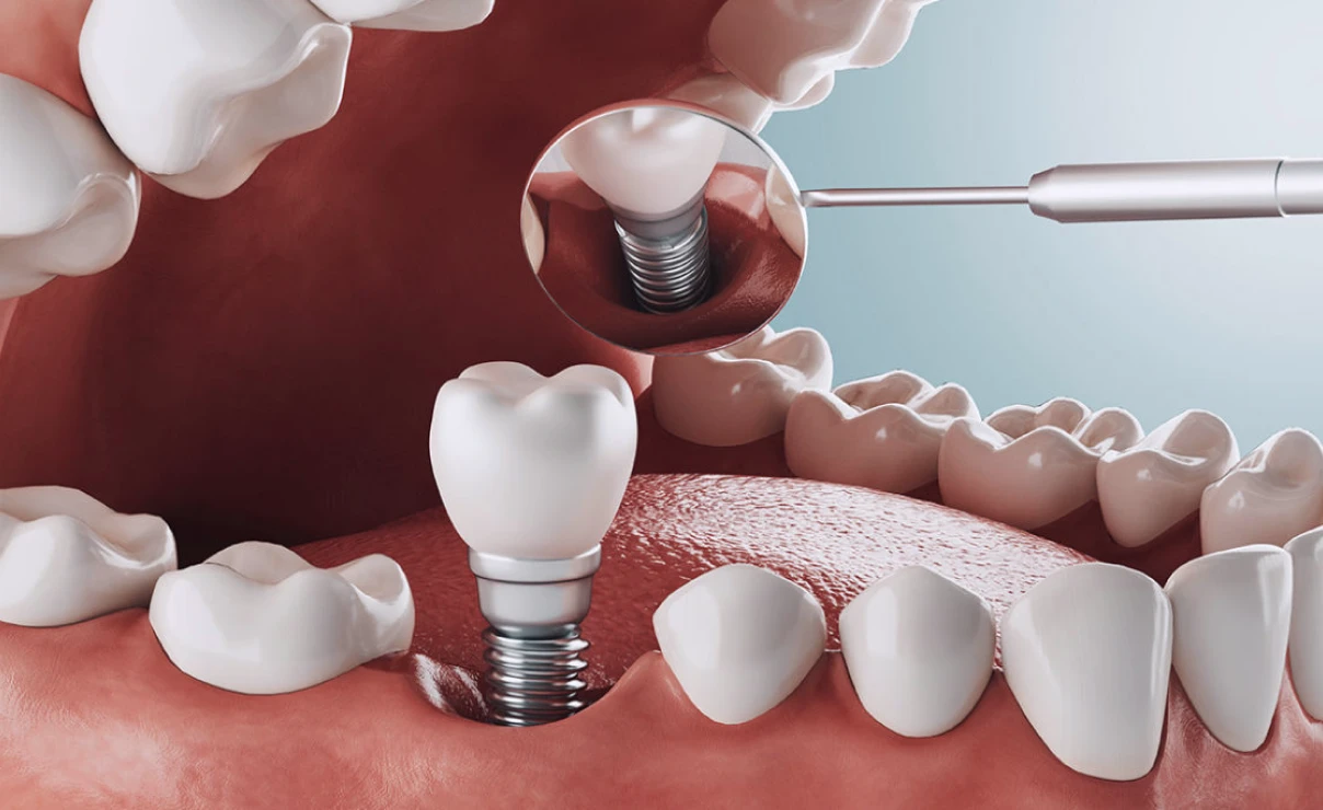 Extraction implantation immédiate à la clinique dentaire Trèfle d'Or à Lancy (1212)