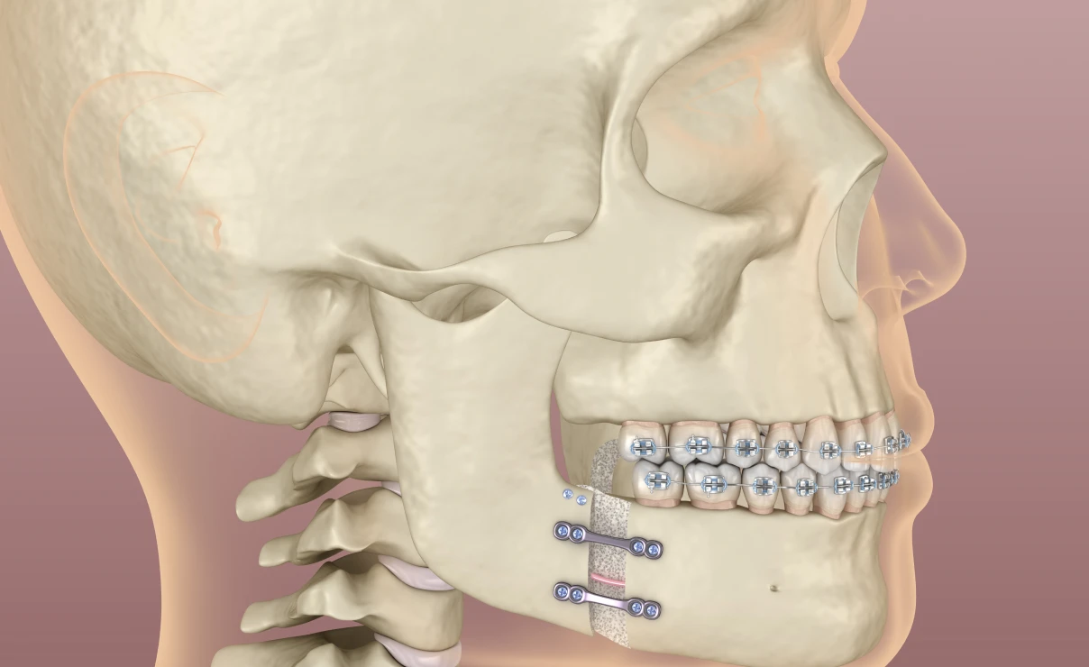 Orthodontie chirurgicale à la clinique dentaire Trèfle d'Or à Lancy 1212, près de Genève