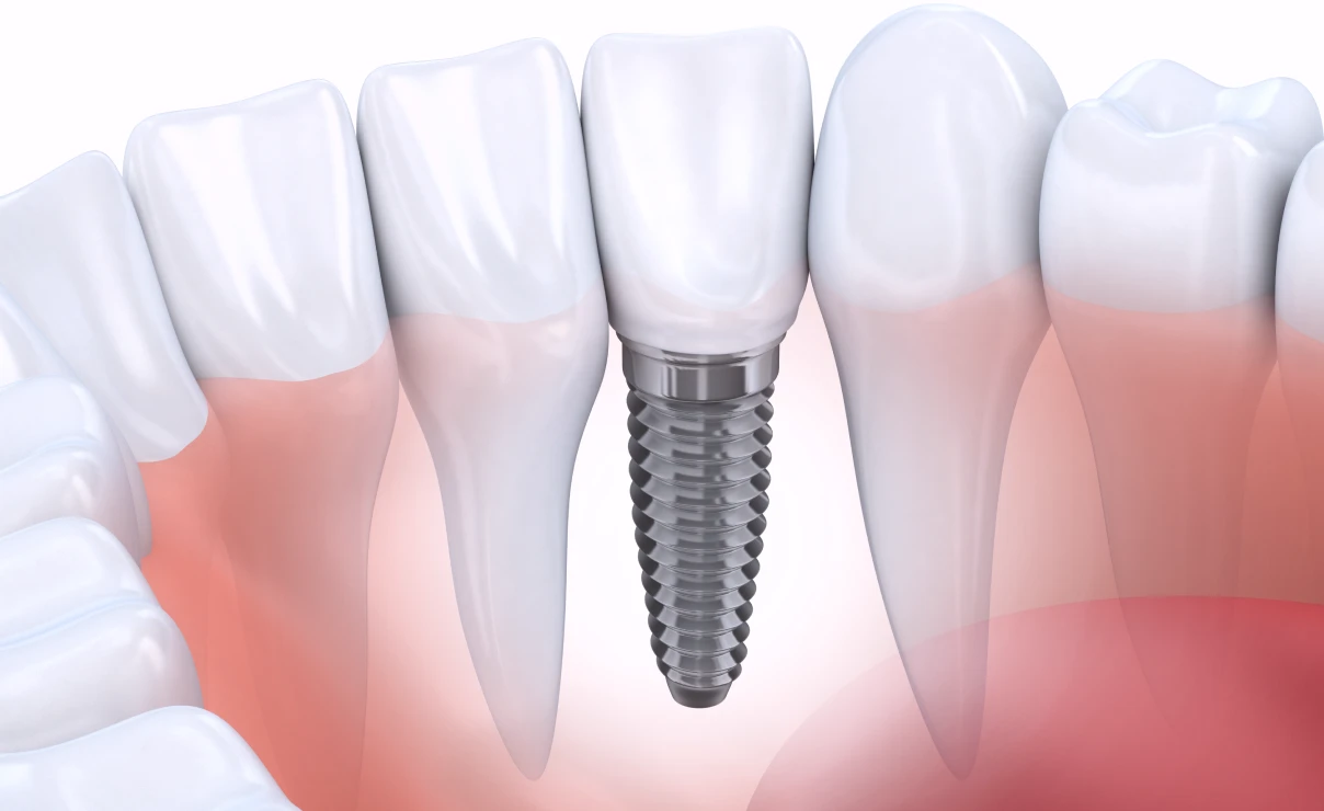 Implant unitaire : traitements à la clinique dentaire Trèfle d'Or à Lancy (1212)