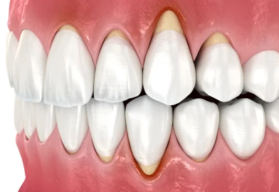 Récession gingivale : traitement à la clinique dentaire Trèfle d'Or à Lancy 1212