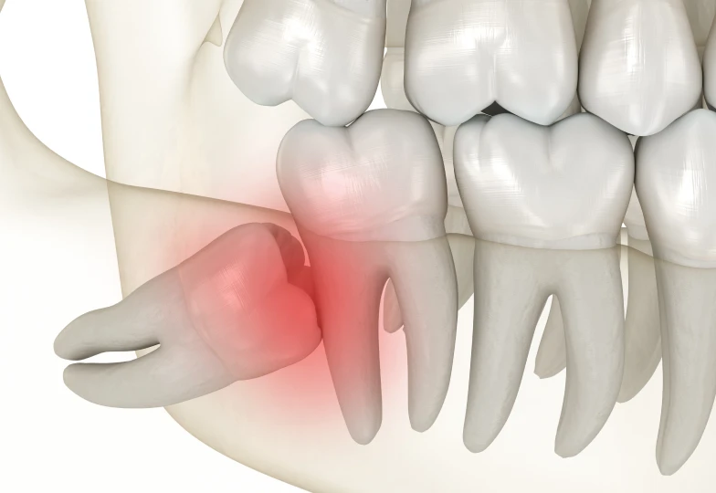 Traitement des dents de sagesse incluses à la clinique dentaire Trèfle d'Or à Lancy 1212